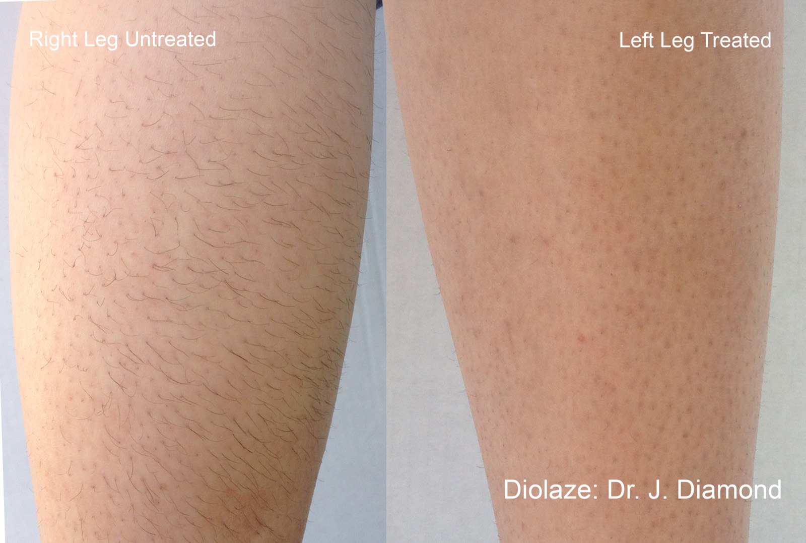 Diolaze laser hair removal &mdash; treated vs untreated