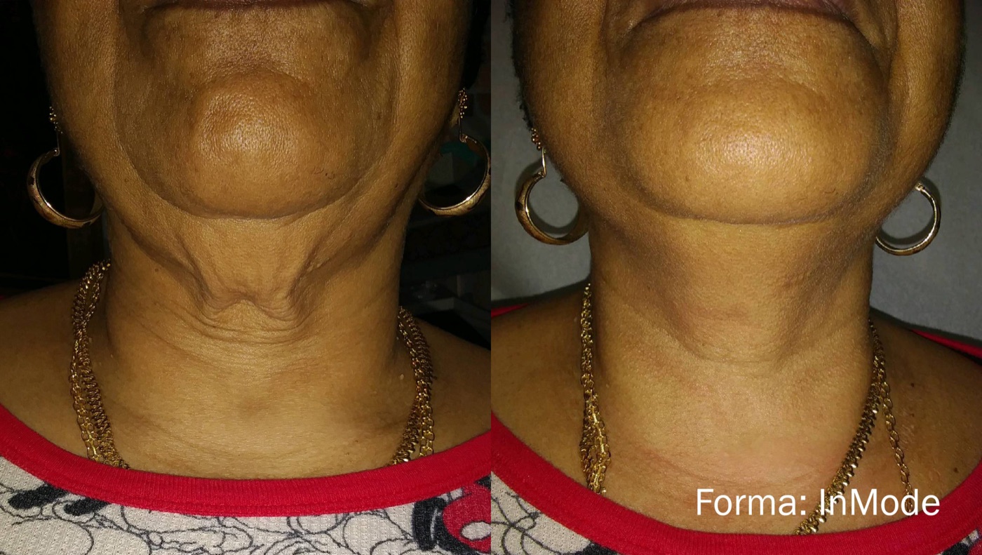Forma RF skin tightening before and after &mdash; firmer, smoother neck skin after treatment