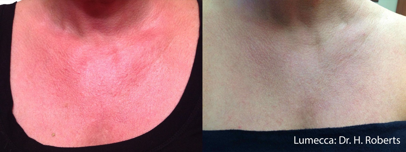 Lumecca IPL before and after &mdash; redness and vascular irregularity on the chest and décolleté visibly reduced